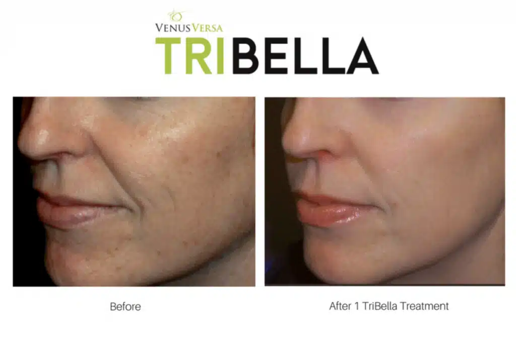 TriBella before and after results
