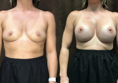 Breast Augmentation before and after photo