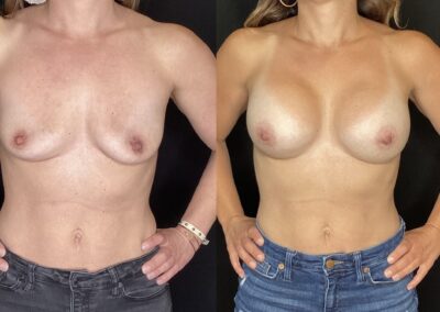 Breast Augmentation before and after photo
