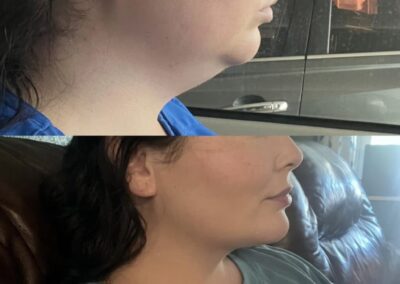 Neck Lift before and after photos