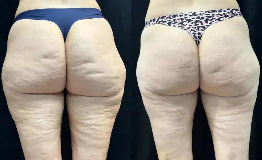 Avéli (Cellulite Removal) before and after photo by Fort Worth Plastic Surgery in Fort Worth, TX