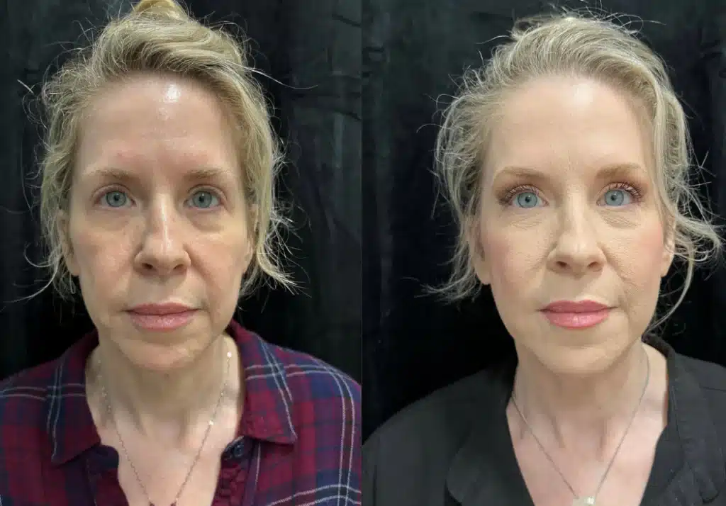 MyEllevate before and after photo by Fort Worth Plastic Surgery in Fort Worth, TX