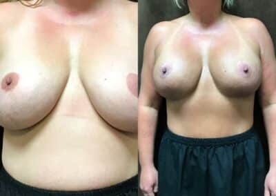 Mommy Makeover before and after photo