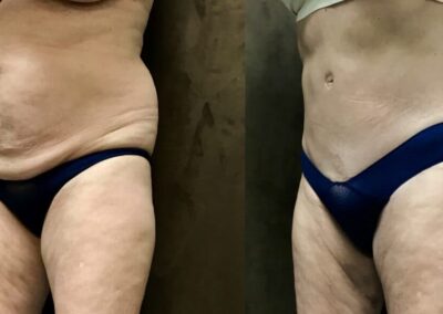 Tummy Tuck before and after photo