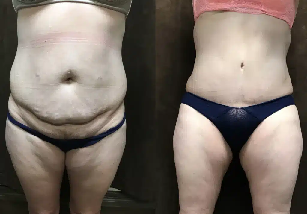 Tummy Tuck before and after photo by Fort Worth Plastic Surgery in Fort Worth, TX