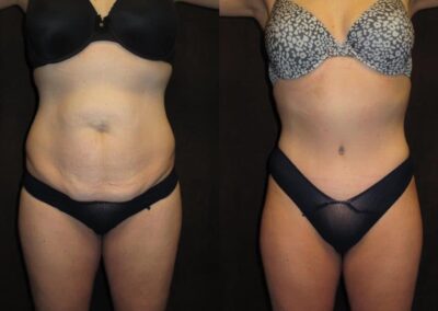 Tummy Tuck before and after photo