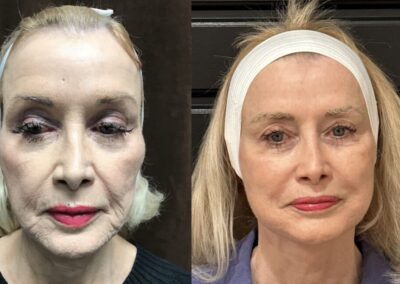 Neck Lift before and after photos