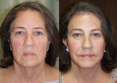 Neck Lift before and after photos