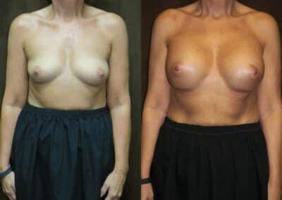 Breast Augmentation before and after photo