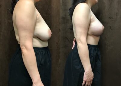 Breast Lift (Mastopexy) before and after photo