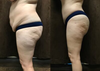 Mommy Makeover before and after photo