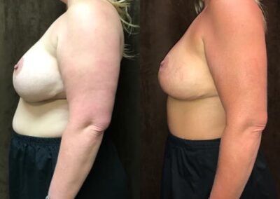 Mommy Makeover before and after photo