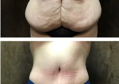 Tummy Tuck before and after photo