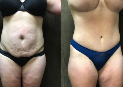 Tummy Tuck before and after photo