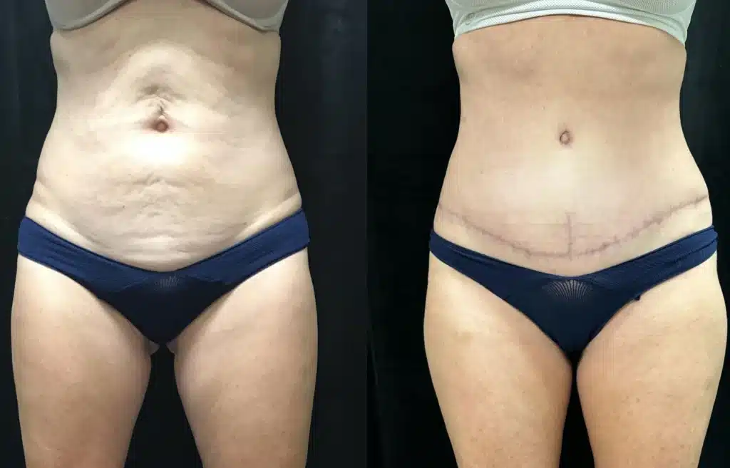 Tummy Tuck before and after photo by Fort Worth Plastic Surgery in Fort Worth, TX