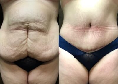 Tummy Tuck before and after photo