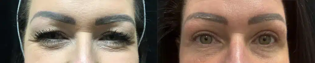 Eyelid Surgery before and after photo by Fort Worth Plastic Surgery in Fort Worth, TX