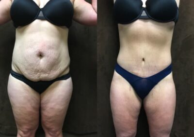 Mommy Makeover before and after photo