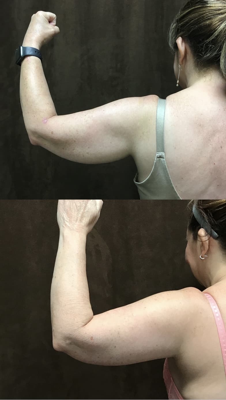 Upper Arm Lift (Brachioplasty) before and after photo