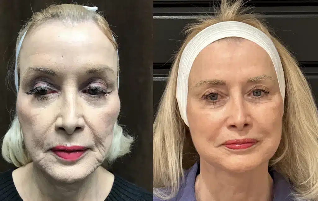 Neck Lift before and after photo by Fort Worth Plastic Surgery in Fort Worth, TX