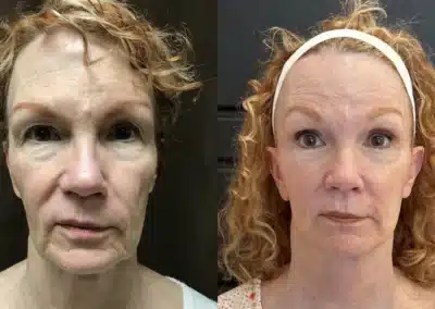 Facelift before and after photo by Fort Worth Plastic Surgery in Fort Worth, TX