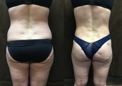 Mommy Makeover before and after photo