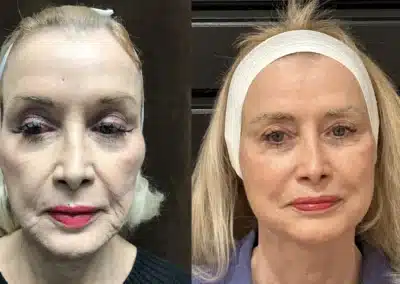 Facelift before and after photo by Fort Worth Plastic Surgery in Fort Worth, TX