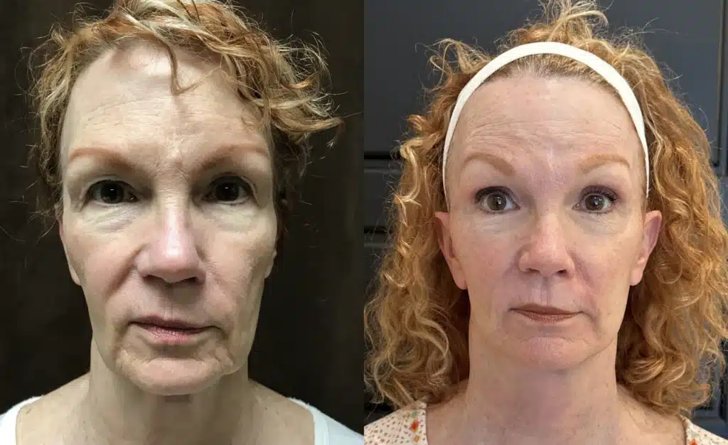 Neck Lift before and after photo by Fort Worth Plastic Surgery in Fort Worth, TX