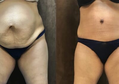 Tummy Tuck before and after photo