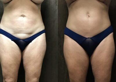 Tummy Tuck before and after photo