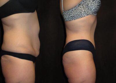 Tummy Tuck before and after photo