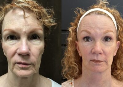 Neck Lift before and after photos