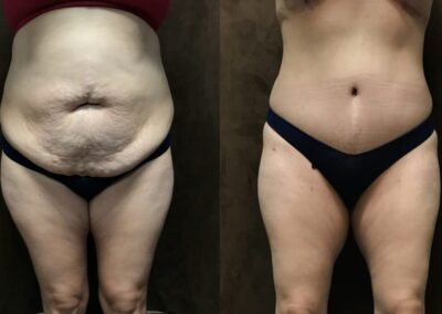 Tummy Tuck before and after photo