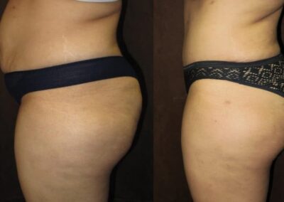 Tummy Tuck before and after photo