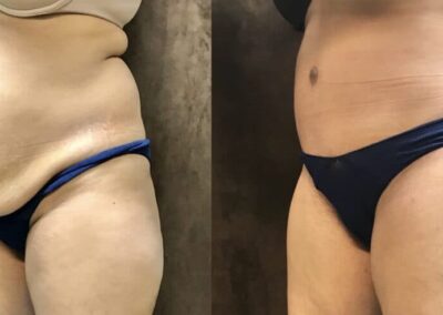 Tummy Tuck before and after photo
