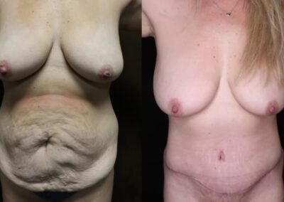 Tummy Tuck before and after photo