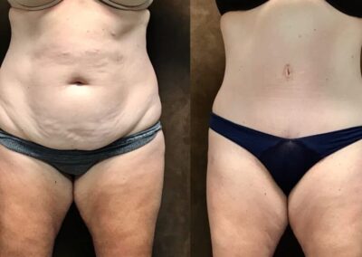 Tummy Tuck before and after photo
