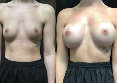Breast Augmentation before and after photo