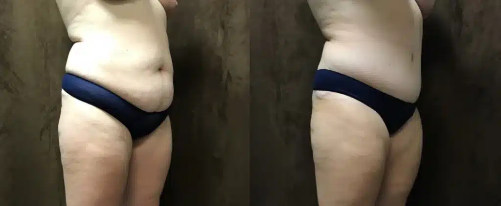 Tummy Tuck before and after photo by Fort Worth Plastic Surgery in Fort Worth, TX