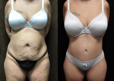 Tummy Tuck before and after photo