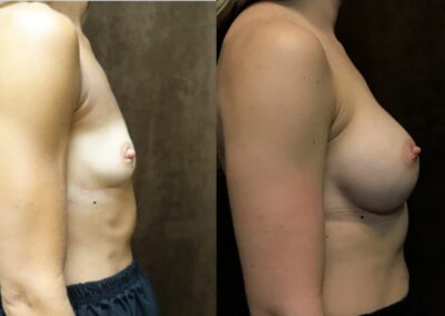 Breast Augmentation before and after photo