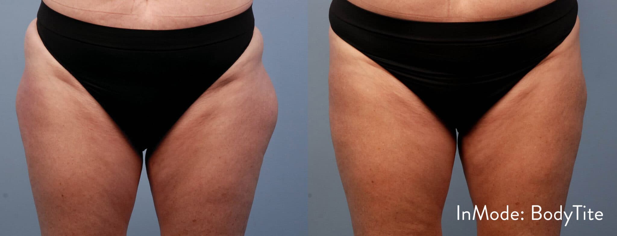 BodyTite by INMODE before and after photo