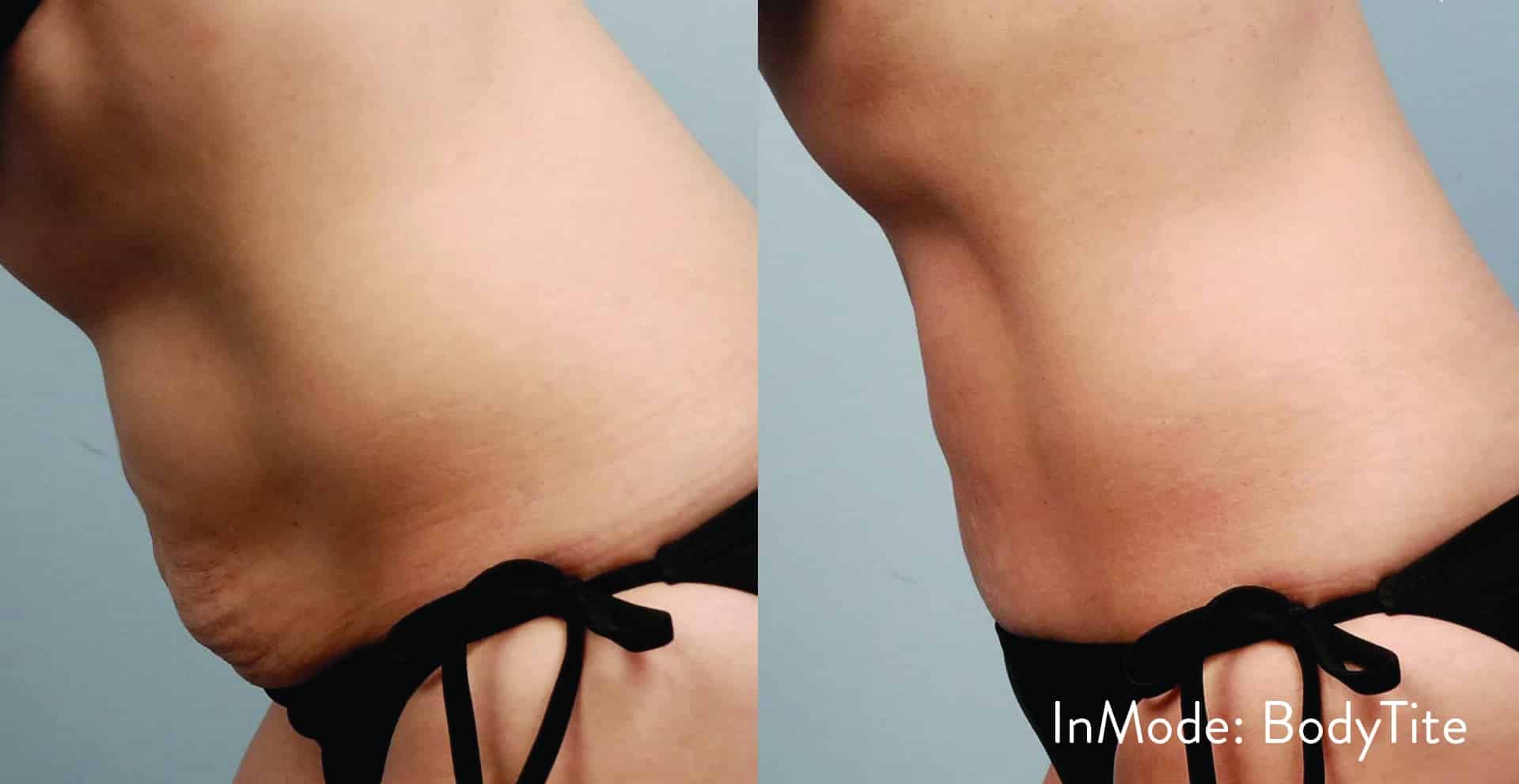 BodyTite by INMODE before and after photo