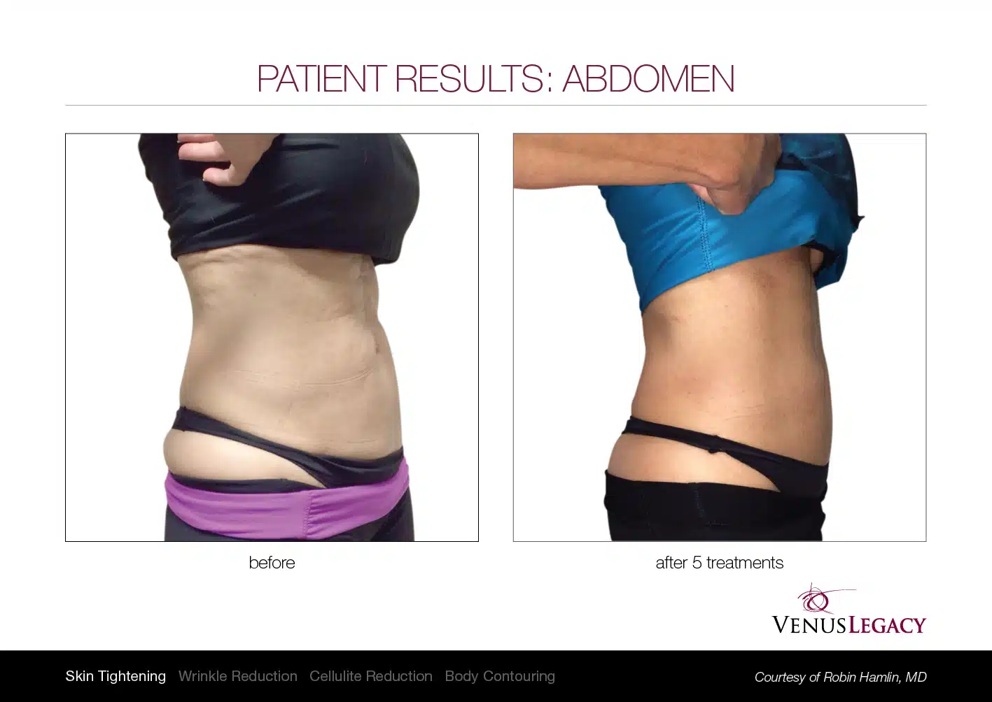 Abdomen contouring before and after results