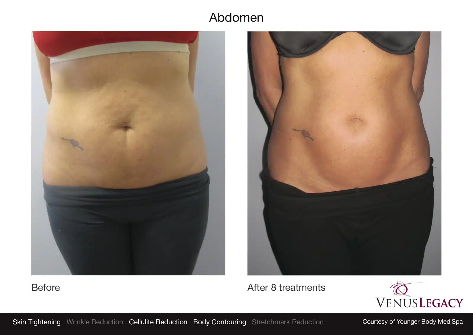 Abdomen contouring before and after results
