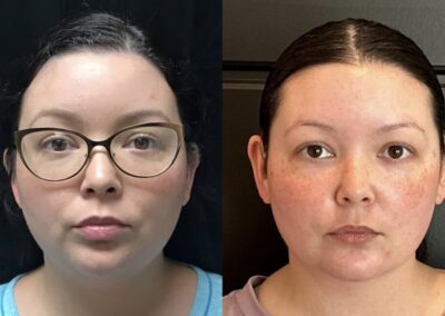 Neck Lift before and after photos