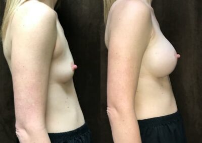 Breast Augmentation before and after photo