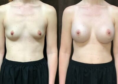 Breast Augmentation before and after photo