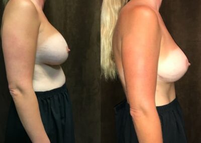 Breast Lift (Mastopexy) before and after photo