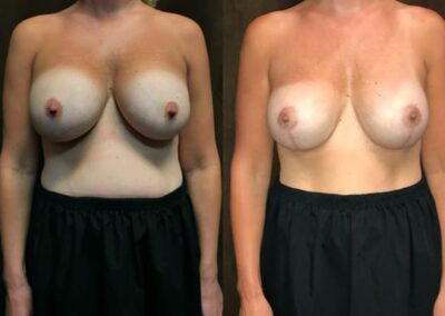 Breast Augmentation before and after photo